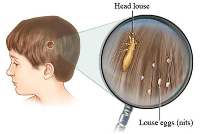 Doctors Will Not Tell You This – Cheap Way To Get Rid Of The Head Lice ...